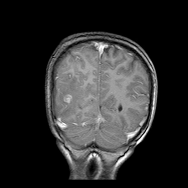 File:Cerebral tuberculoma (Radiopaedia 41152-43932 Coronal T1 C+ 18).jpg