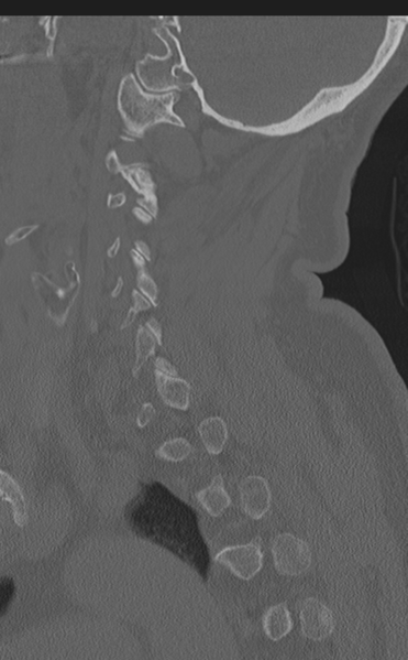 File:Cervical canal stenosis - OPLL and osteophytes (Radiopaedia 47329-51910 Sagittal bone window 21).png