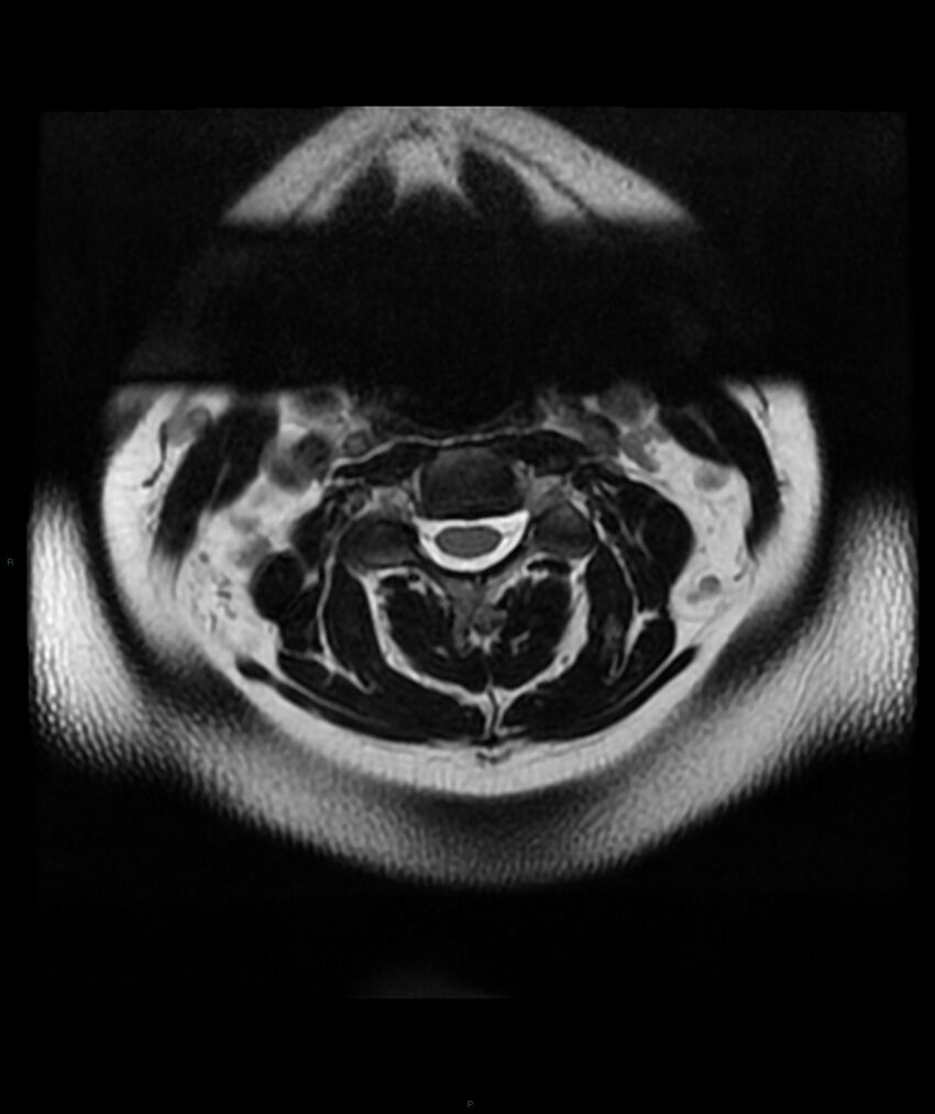 Cervical disc prolapse (Radiopaedia 80258-93598 Axial T2 8).jpg