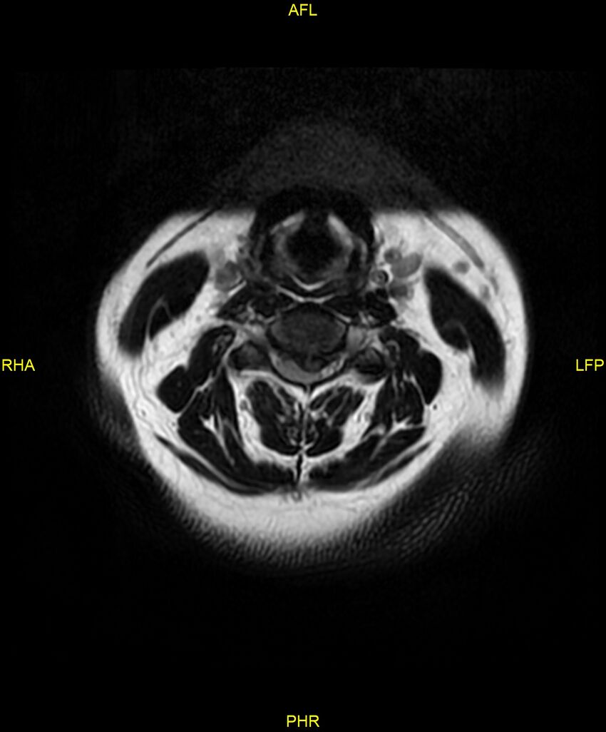 Cervical disc protrusion (Radiopaedia 87147-103415 Axial T2 10).jpg