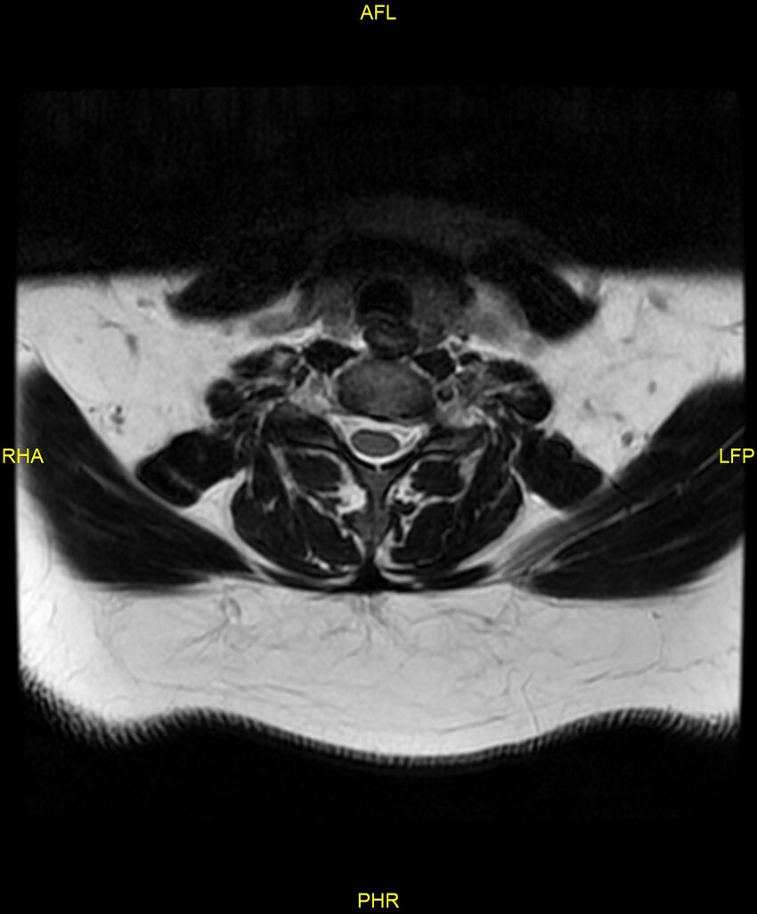 Cervical disc protrusion (Radiopaedia 87147-103415 Axial T2 47).jpg