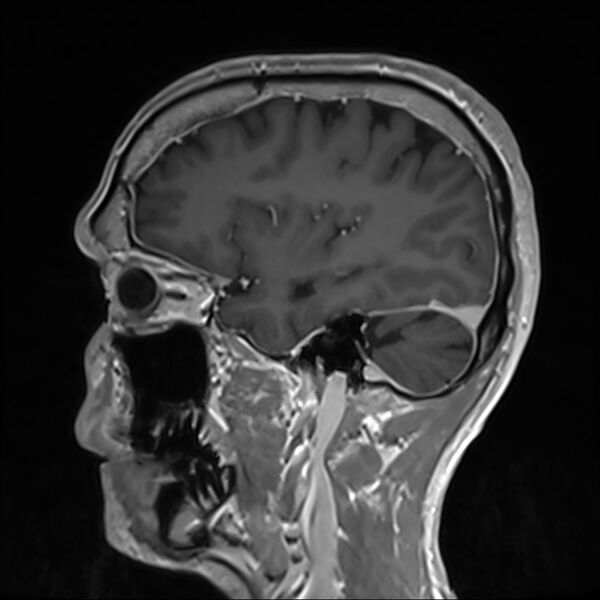 File:Cervical dural CSF leak on MRI and CT treated by blood patch (Radiopaedia 49748-54995 G 24).jpg