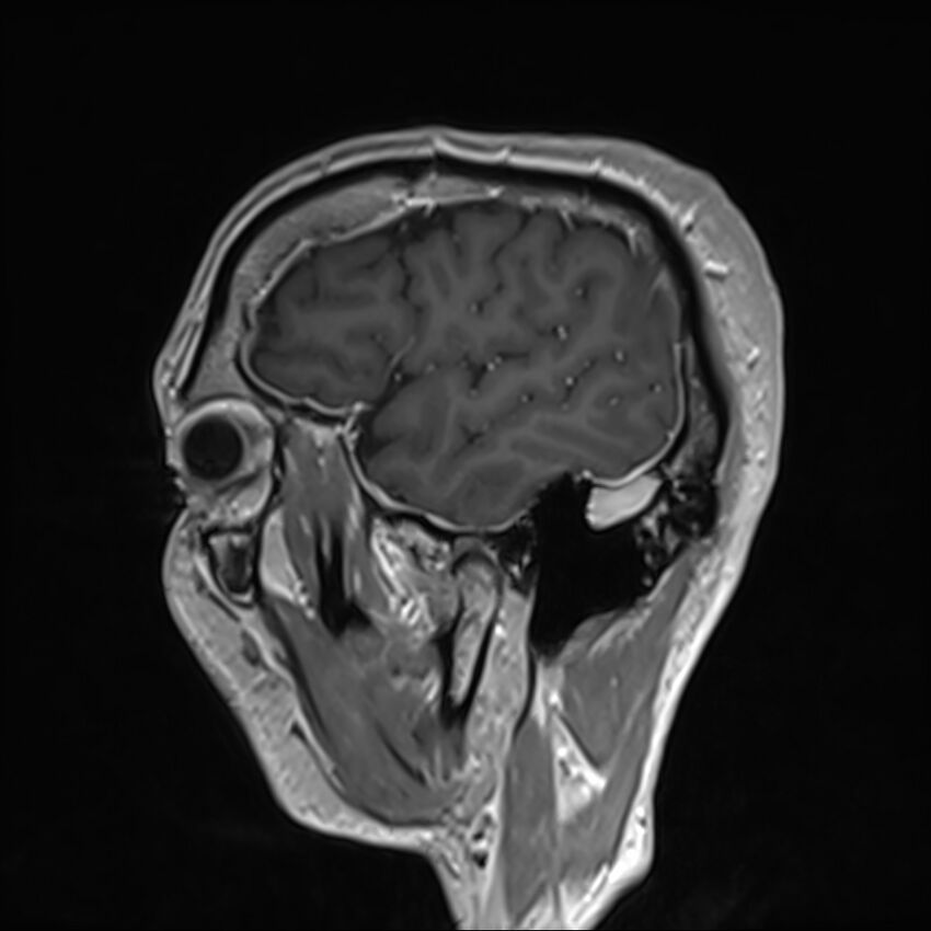 Cervical dural CSF leak on MRI and CT treated by blood patch (Radiopaedia 49748-54995 G 6).jpg