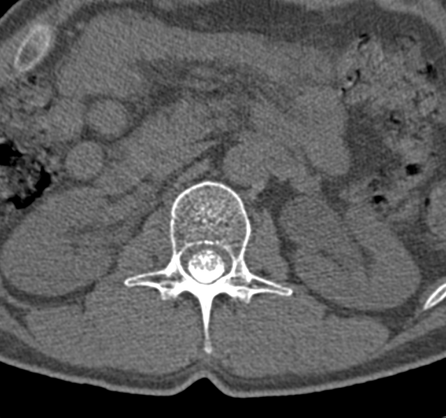 File:Cervical dural CSF leak on MRI and CT treated by blood patch (Radiopaedia 49748-54996 B 90).png
