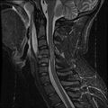 Cervical flexion teardrop fracture with cord hemorrhage (Radiopaedia 32497-33455 Sagittal STIR 9).jpg