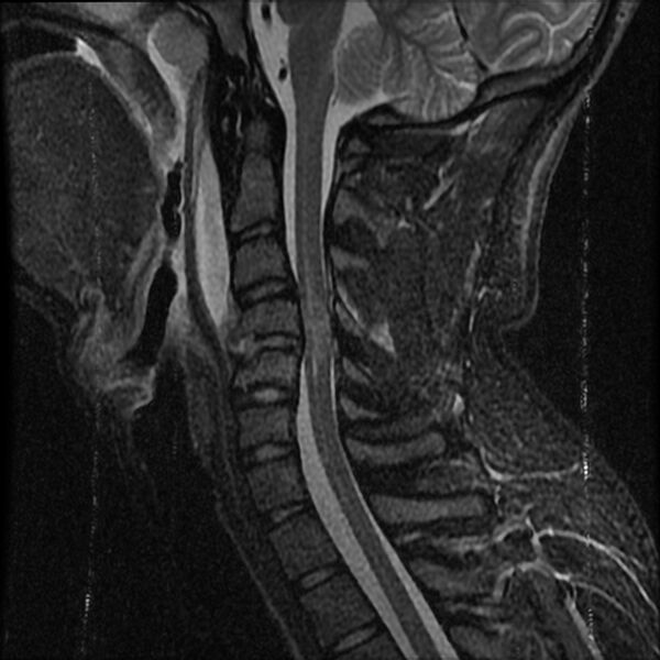 File:Cervical flexion teardrop fracture with cord hemorrhage (Radiopaedia 32497-33455 Sagittal STIR 9).jpg