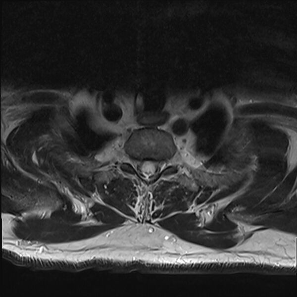 File:Cervical tumor-like myelopathy due to Type V dAVF (Radiopaedia 82461-96604 Axial T2 35).jpg