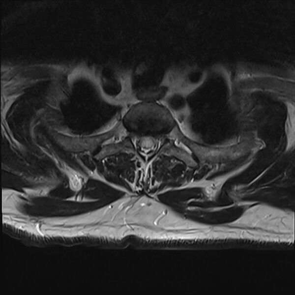 File:Cervical tumor-like myelopathy due to Type V dAVF (Radiopaedia 82461-96604 D 1).jpg
