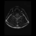 Cervical vertebrae metastasis (Radiopaedia 78814-91667 Axial T2 8).png