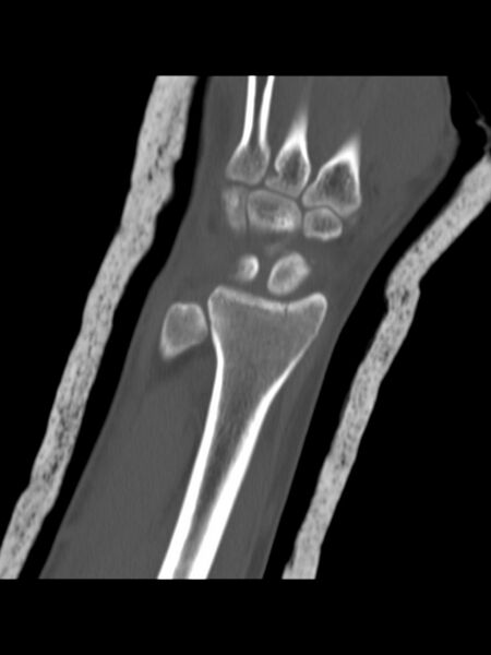 File:Chauffeur's (Hutchinson) fracture (Radiopaedia 58043-65079 Coronal bone window 9).jpg