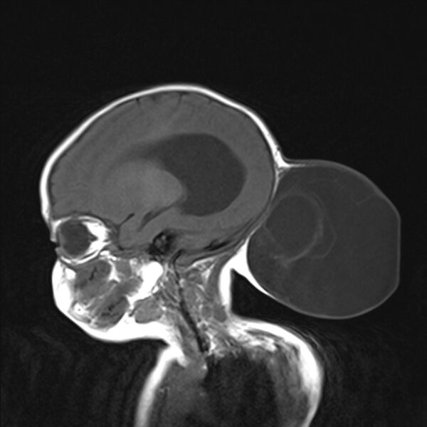 File:Chiari III malformation with occipital encephalocele (Radiopaedia 79446-92559 Sagittal T1 15).jpg