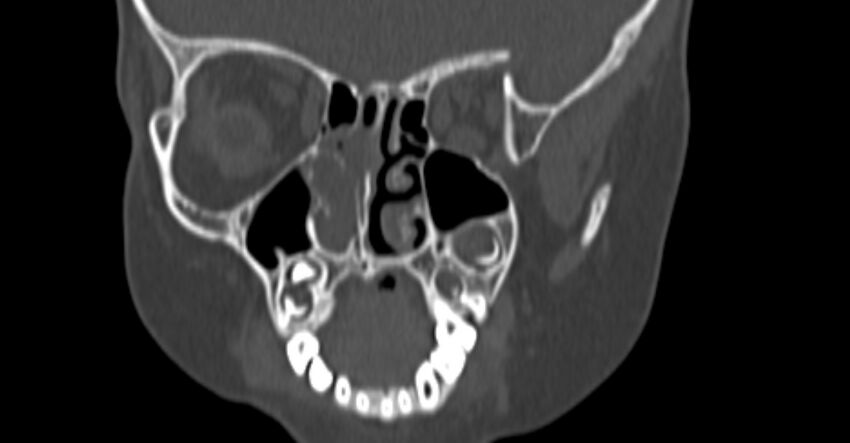 Choanal atresia (Radiopaedia 51295-56972 Coronal bone window 38).jpg