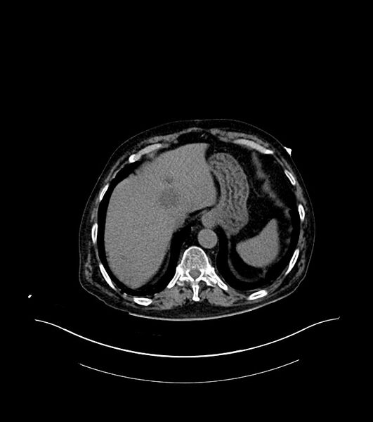 File:Cholangiocarcinoma with cerebral metastases (Radiopaedia 83519-98629 Axial non-contrast 13).jpg