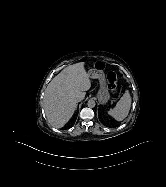 File:Cholangiocarcinoma with cerebral metastases (Radiopaedia 83519-98629 Axial non-contrast 19).jpg