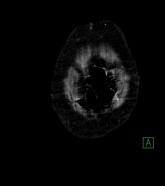 File:Cholangiocarcinoma with cerebral metastases (Radiopaedia 83519-98629 E 3).jpg