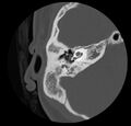 Cholesteatoma (Radiopaedia 20296-20217 bone window 24).jpg