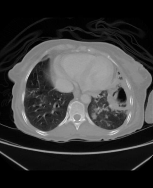 File:Chondrosarcoma (Radiopaedia 79427-92535 Axial lung window 39).jpg
