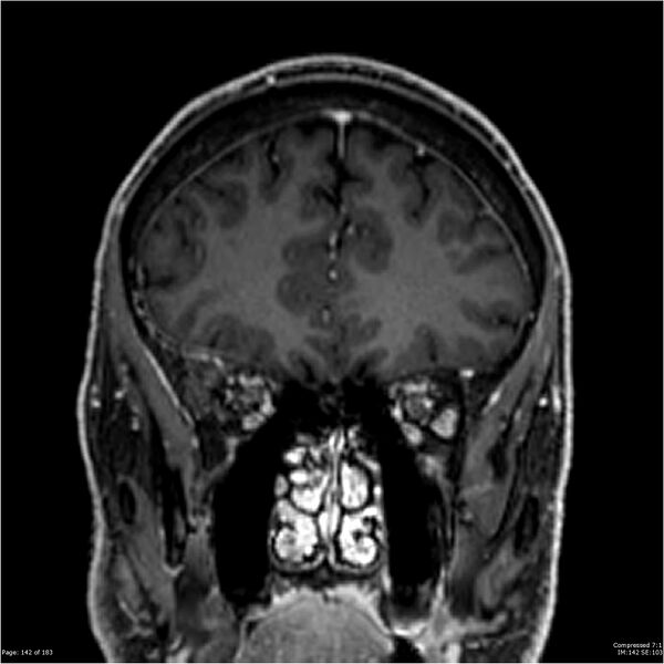File:Chondrosarcoma of skull base- grade II (Radiopaedia 40948-43654 Coronal T1 C+ 53).jpg