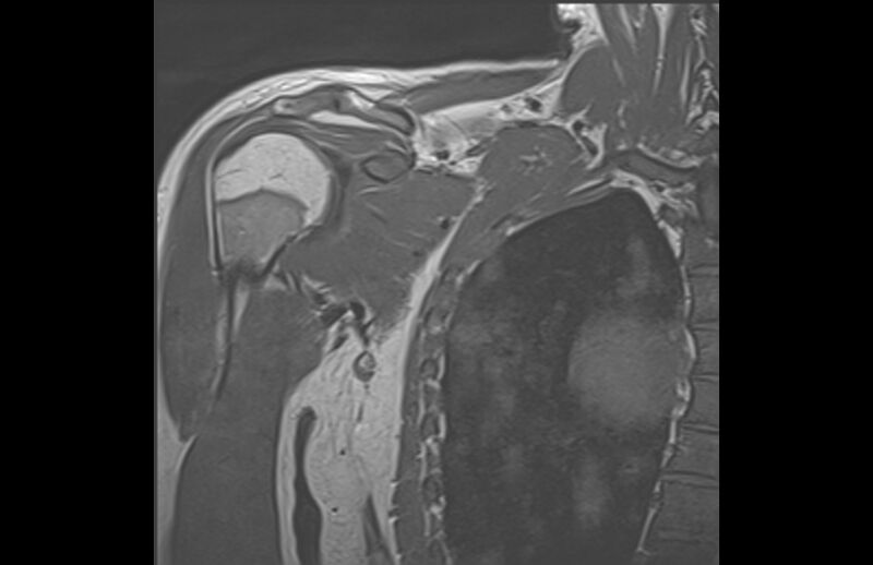 File:Choriocarcinoma in the shoulder (Radiopaedia 28603-28861 Coronal T1 4).jpg