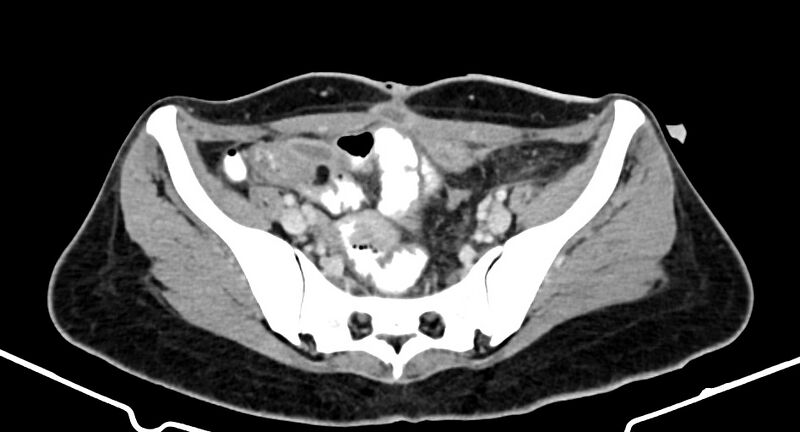 File:Choriocarcinoma liver metastases (Radiopaedia 74768-85766 A 164).jpg