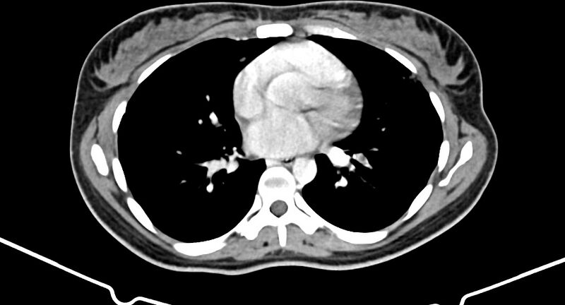 File:Choriocarcinoma liver metastases (Radiopaedia 74768-85766 A 3).jpg