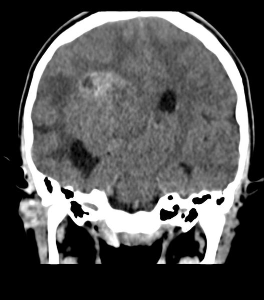 File:Choroid plexus carcinoma (Radiopaedia 91013-108552 Coronal non-contrast 46).jpg