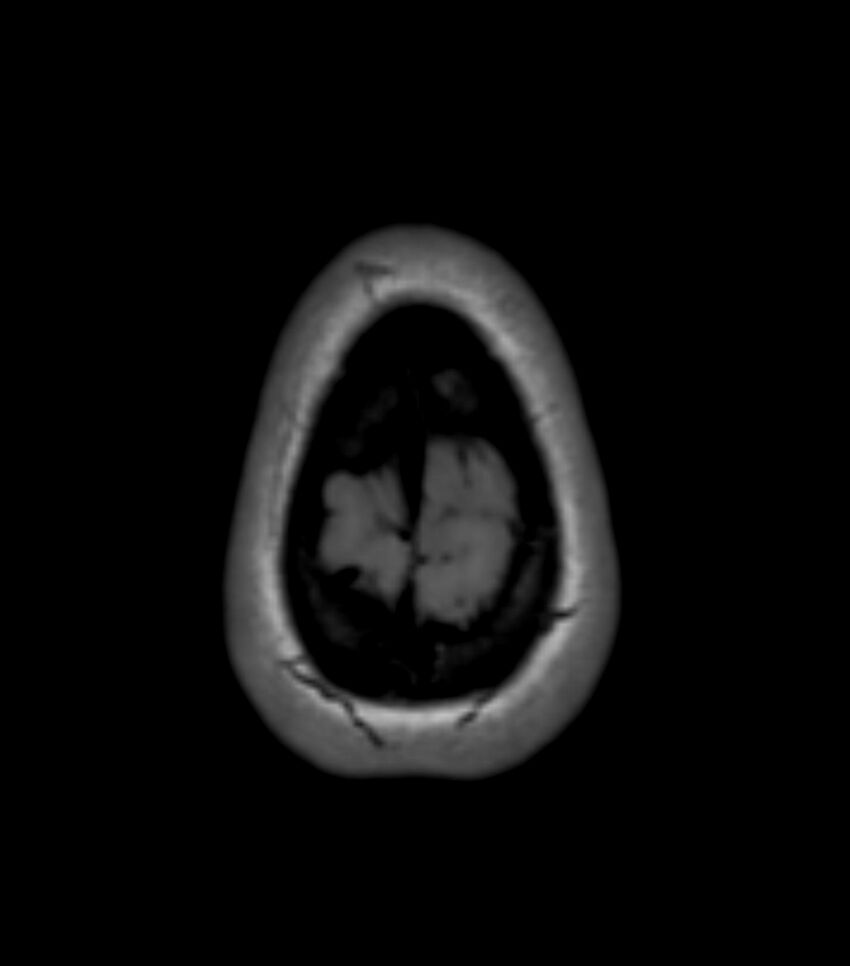 Choroid plexus carcinoma (Radiopaedia 91013-108553 Axial T1 156).jpg
