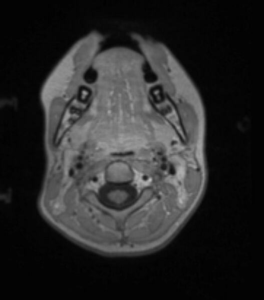 File:Choroid plexus carcinoma (Radiopaedia 91013-108553 Axial T1 C+ 37).jpg
