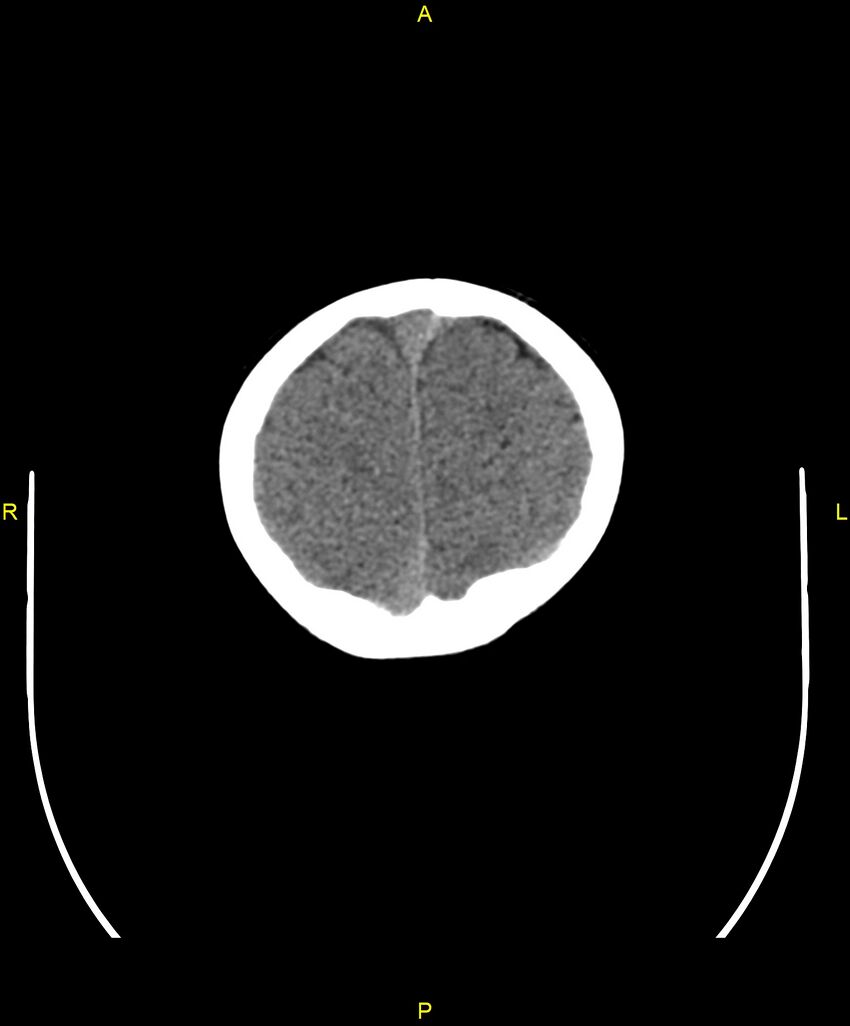 Choroidal fissure cyst (Radiopaedia 89481-106465 Axial non-contrast 107).jpg