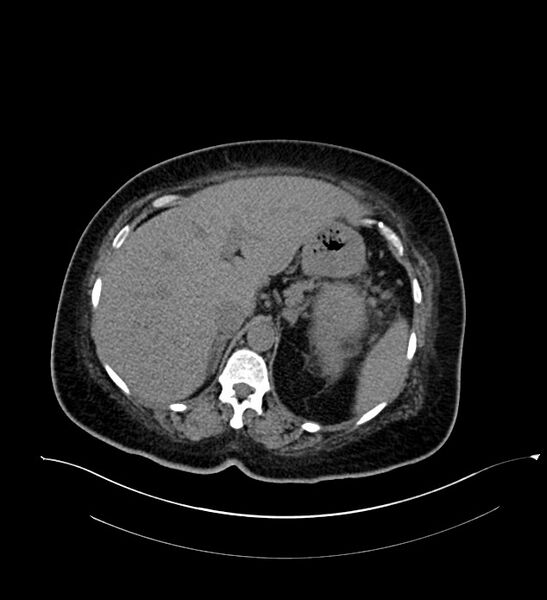 File:Chromophobe renal cell carcinoma (Radiopaedia 84239-99519 Axial non-contrast 49).jpg
