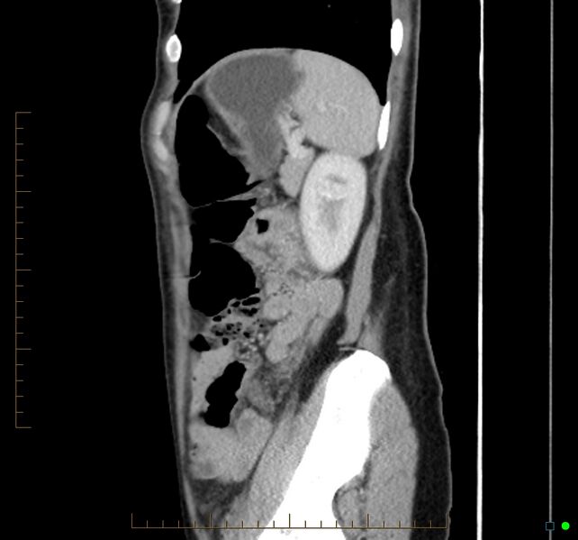 File:Chronic abscess due to "dropped" appendicoliths following appendectomy for perforated appendix (Radiopaedia 58805-66344 D 13).jpg