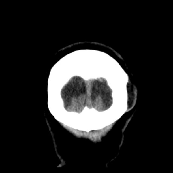 File:Chronic bilateral occipital lobe infarcts (Radiopaedia 31276-31996 Coronal non-contrast 46).jpg