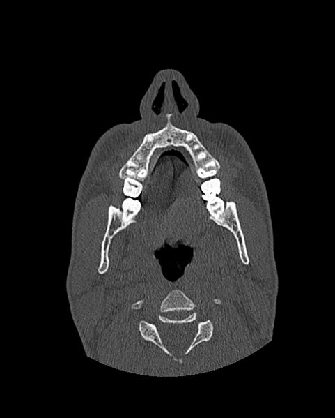 File:Chronic maxillary sinusitis caused by a foreign body (Radiopaedia 58521-65676 Axial bone window 23).jpg