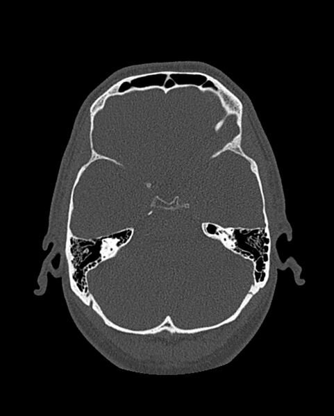 File:Chronic maxillary sinusitis caused by a foreign body (Radiopaedia 58521-65676 Axial bone window 271).jpg