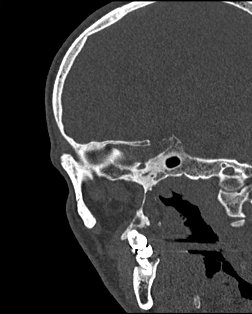 Chronic maxillary sinusitis caused by a foreign body (Radiopaedia 58521-65676 Sagittal bone window 62).jpg