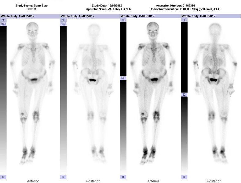 File:Chronic osteomyelitis in a beta thalassemia major patient (Radiopaedia 18793).jpg