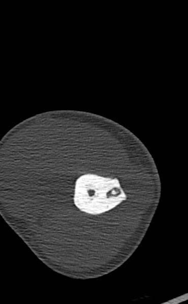 File:Chronic osteomyelitis of the distal humerus (Radiopaedia 78351-90971 Axial bone window 53).jpg
