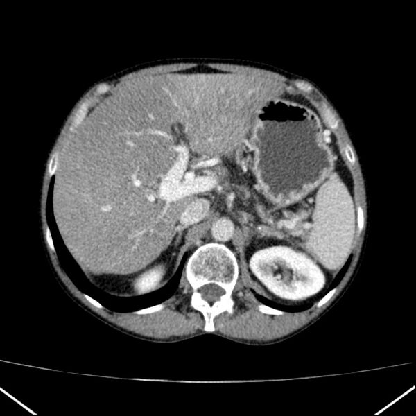 File:Chronic pancreatitis (Radiopaedia 23132-23172 B 16).jpg