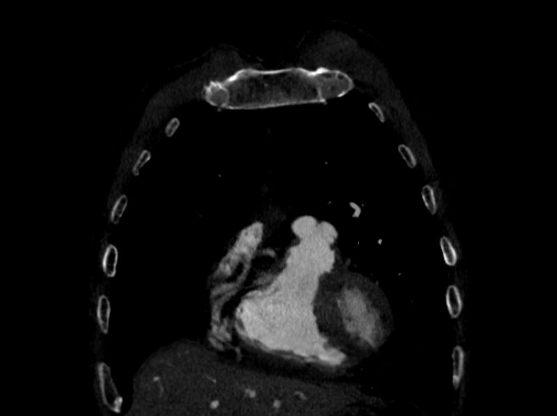 File:Chronic pulmonary embolism (Radiopaedia 91241-108843 A 14).jpg