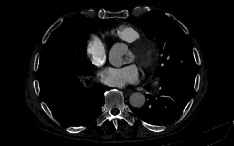 File:Chronic pulmonary embolism (Radiopaedia 91241-108843 B 114).jpg