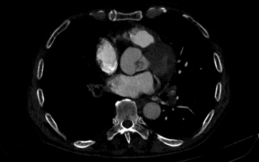 Chronic pulmonary embolism (Radiopaedia 91241-108843 B 114).jpg