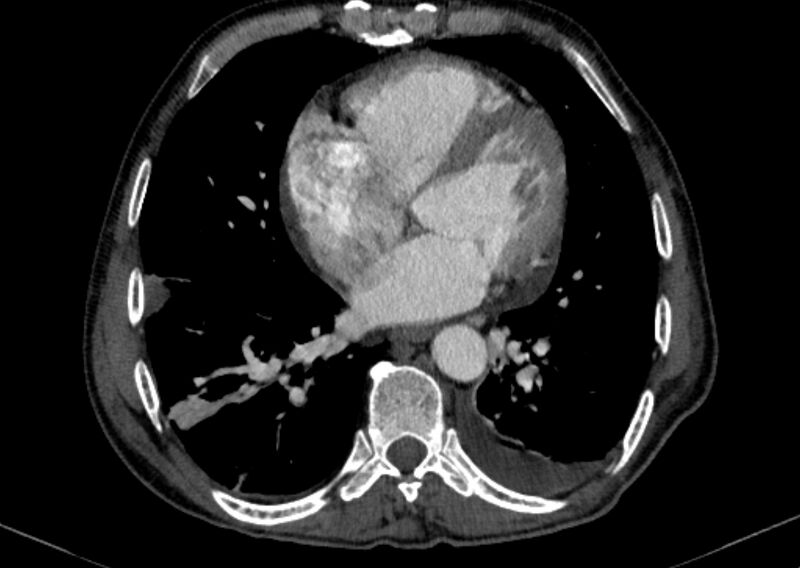 File:Chronic pulmonary embolism with bubbly consolidation (Radiopaedia 91248-108850 C+ arterial phase 100).jpg