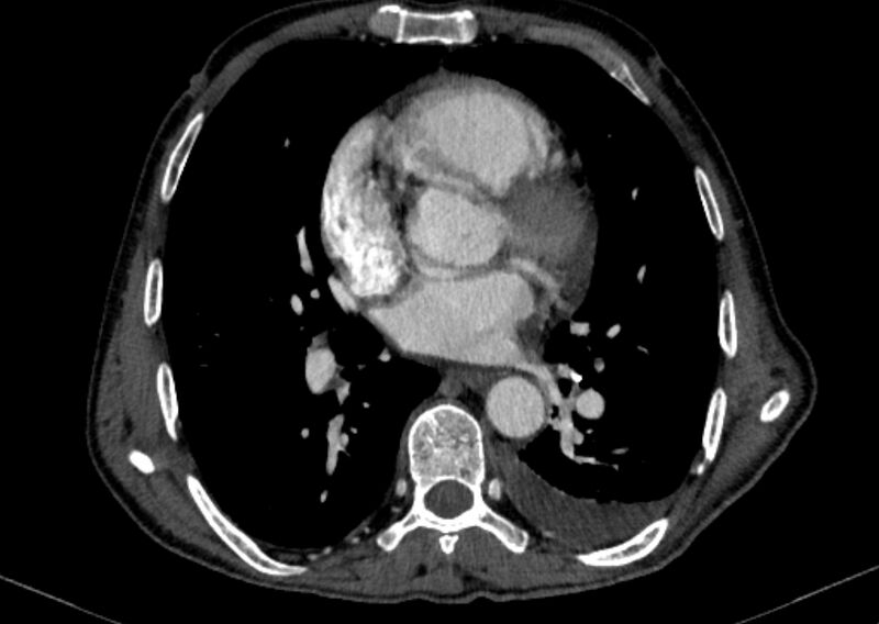 File:Chronic pulmonary embolism with bubbly consolidation (Radiopaedia 91248-108850 C+ arterial phase 87).jpg