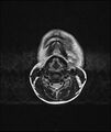 Chronic reactive multifocal osteomyelitis (CRMO) - mandible (Radiopaedia 56405-63069 Axial T2 4).jpg
