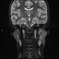 Chronic reactive multifocal osteomyelitis (CRMO) - mandible (Radiopaedia 56405-63069 Coronal STIR 22).jpg