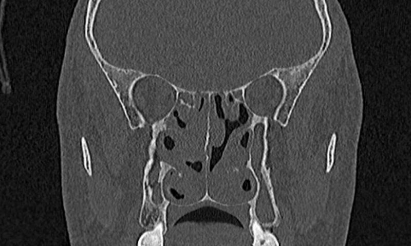 File:Chronic rhinosinusitis (Radiopaedia 65079-74075 Coronal bone window 50).jpg
