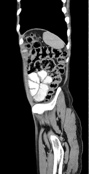 File:Chronic small bowel volvulus (Radiopaedia 75224-86322 C 26).jpg