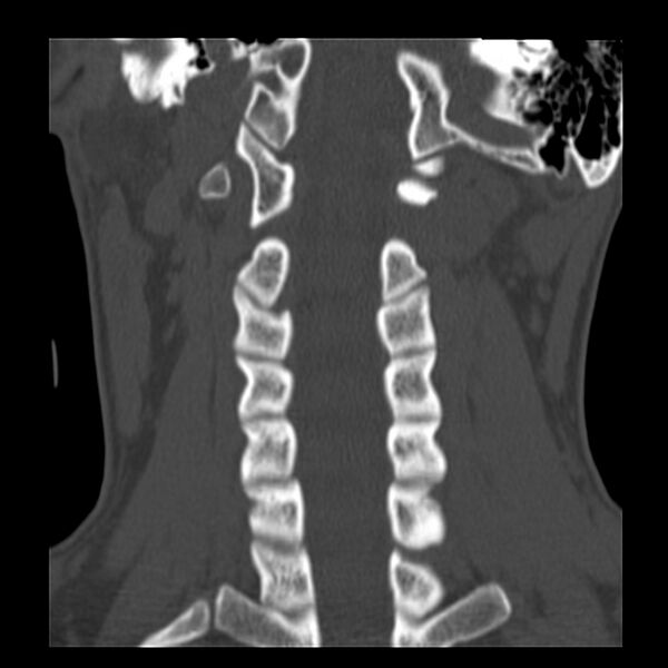 File:Clay-shoveler fracture (Radiopaedia 22568-22590 Coronal bone window 19).jpg