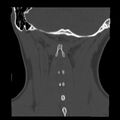 Clay-shoveler fracture (Radiopaedia 22568-22590 Coronal bone window 36).jpg