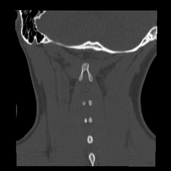 File:Clay-shoveler fracture (Radiopaedia 22568-22590 Coronal bone window 36).jpg